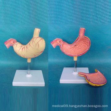 Human Stomach Gastric Ulcer Medical Demonstration Model (R100202)